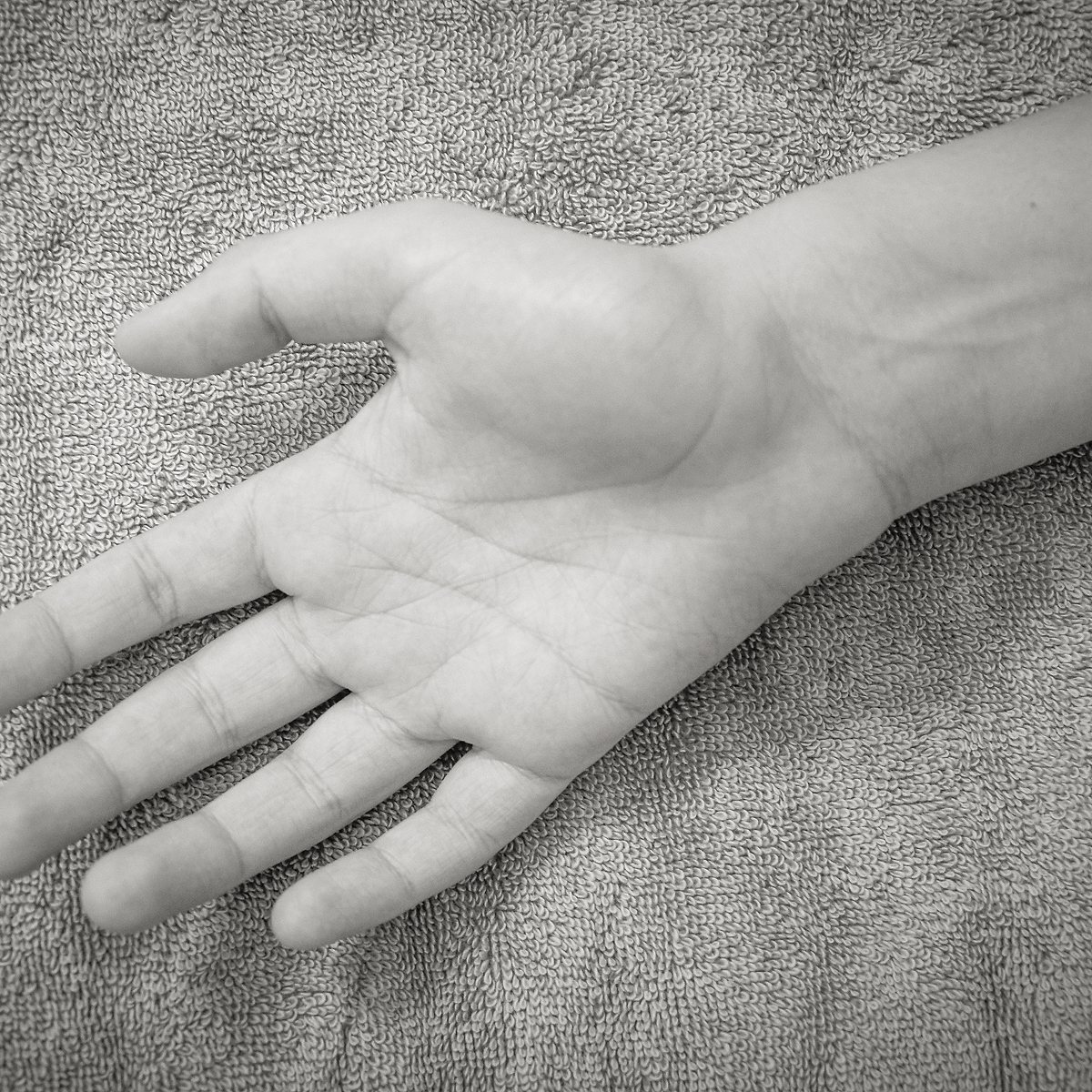 Hand treatment image before view