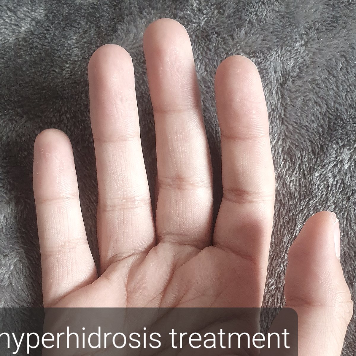 Hyperhidrosis treatment for excessive sweating